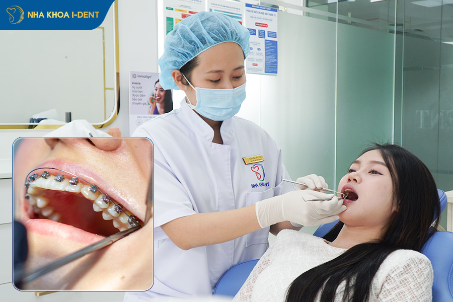 giai đoạn niềng răng hô hàm