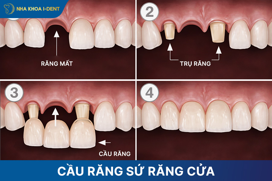 làm cầu răng sứ răng cửa
