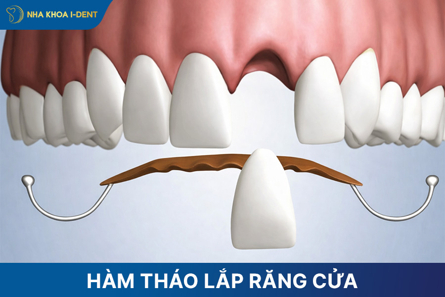 làm hàm tháo lắp răng cửa