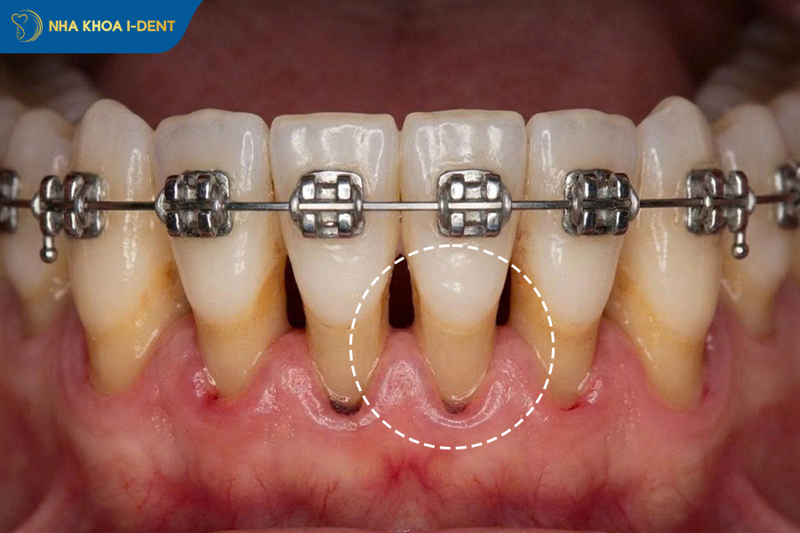 lộ chân răng làm răng yếu đi