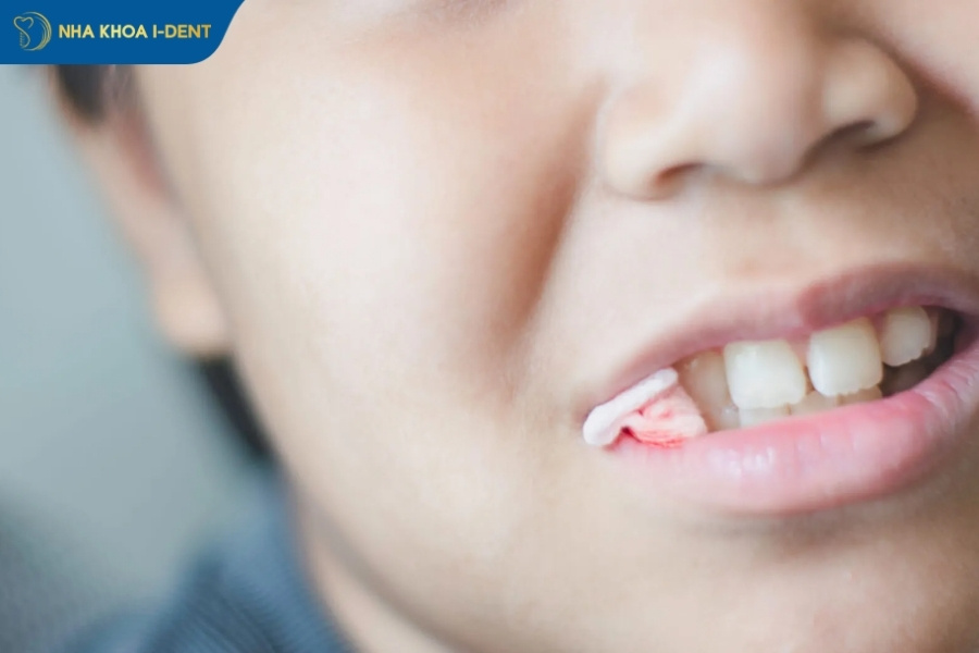 lưu ý sau khi nhổ răng khôn