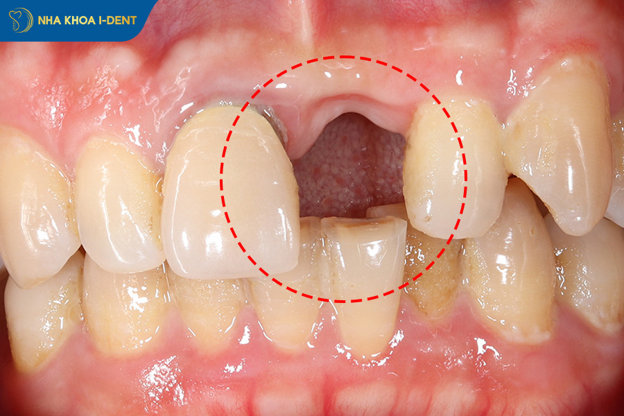 mất răng cửa gây tiêu xương hàm