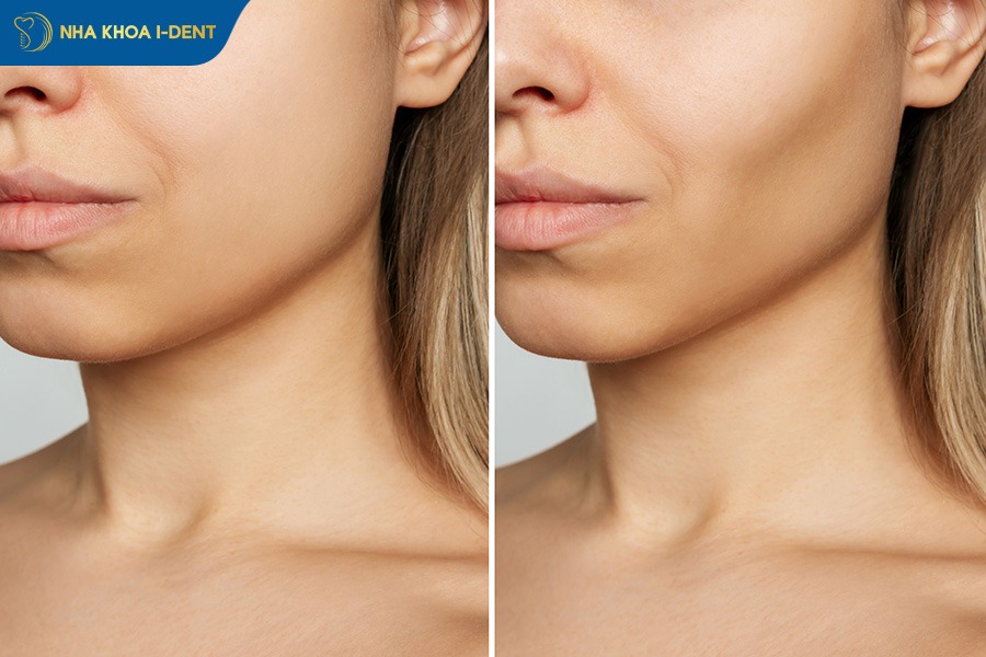 Mất răng số 4 gây hóp má