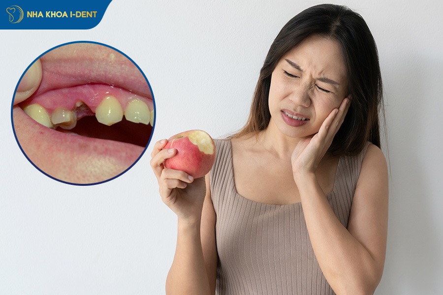 mất răng số 4 hàm dưới