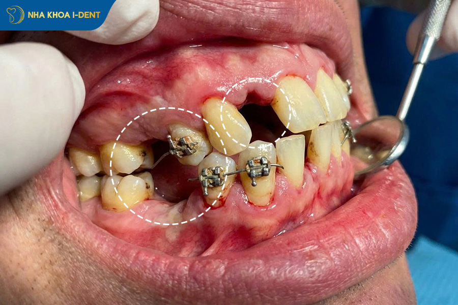 nguy cơ chết tủy và rụng răng