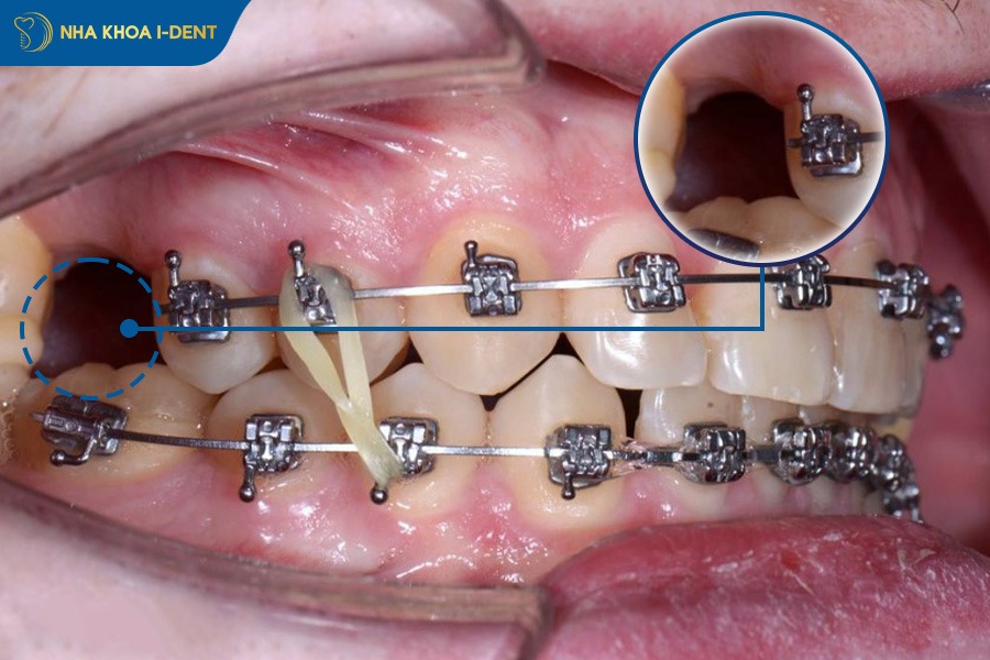 Tận dụng khoảng nhổ răng khôn thay cho nhổ răng số 5 hoặc số 5