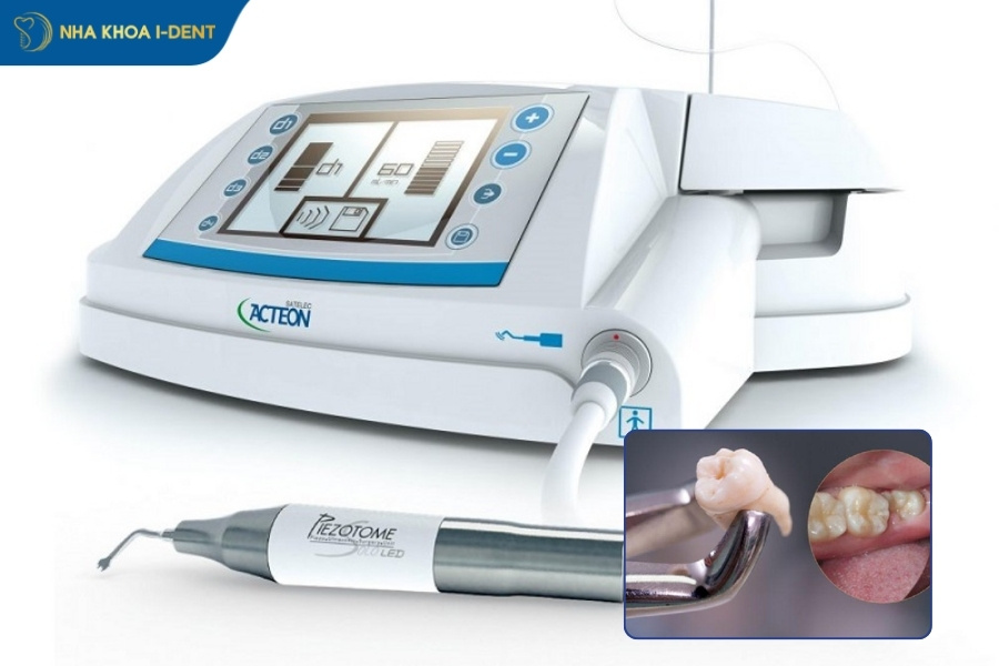 nhổ răng khôn bao lâu thì đầy lợi