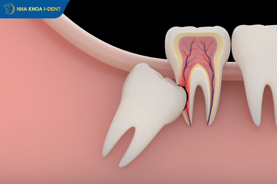 nhổ răng khôn có ảnh hưởng đến thần kinh không