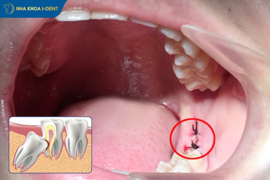 nhổ răng khôn mất bao lâu