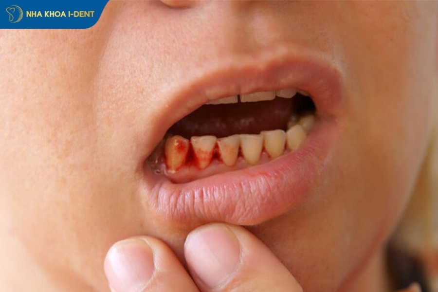 nhổ răng số 4 ảnh hưởng gì không