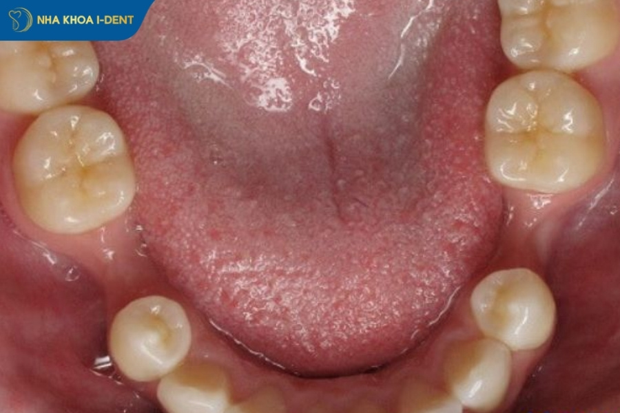 nhổ răng số 4 bao lâu thì lành