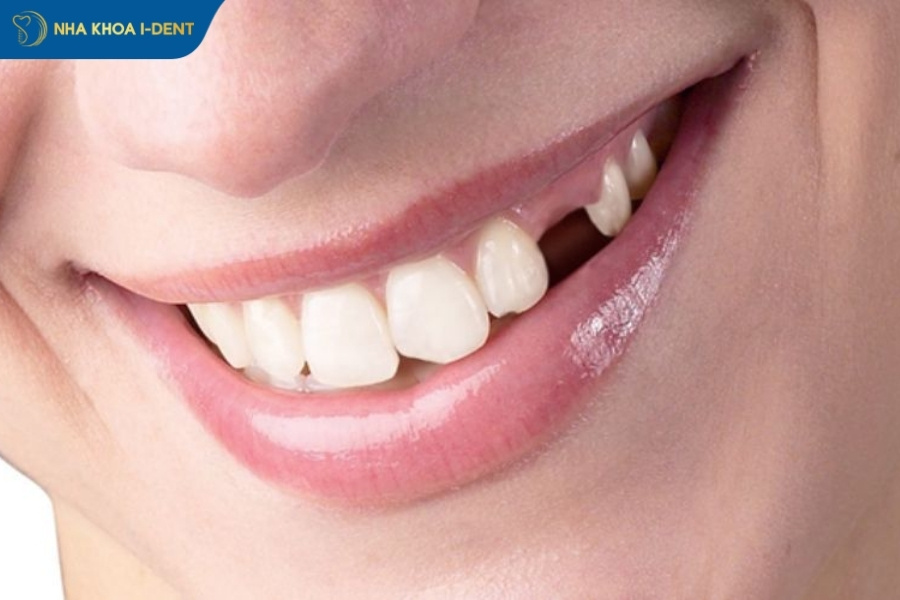 nhổ răng số 4 có ảnh hưởng gì không