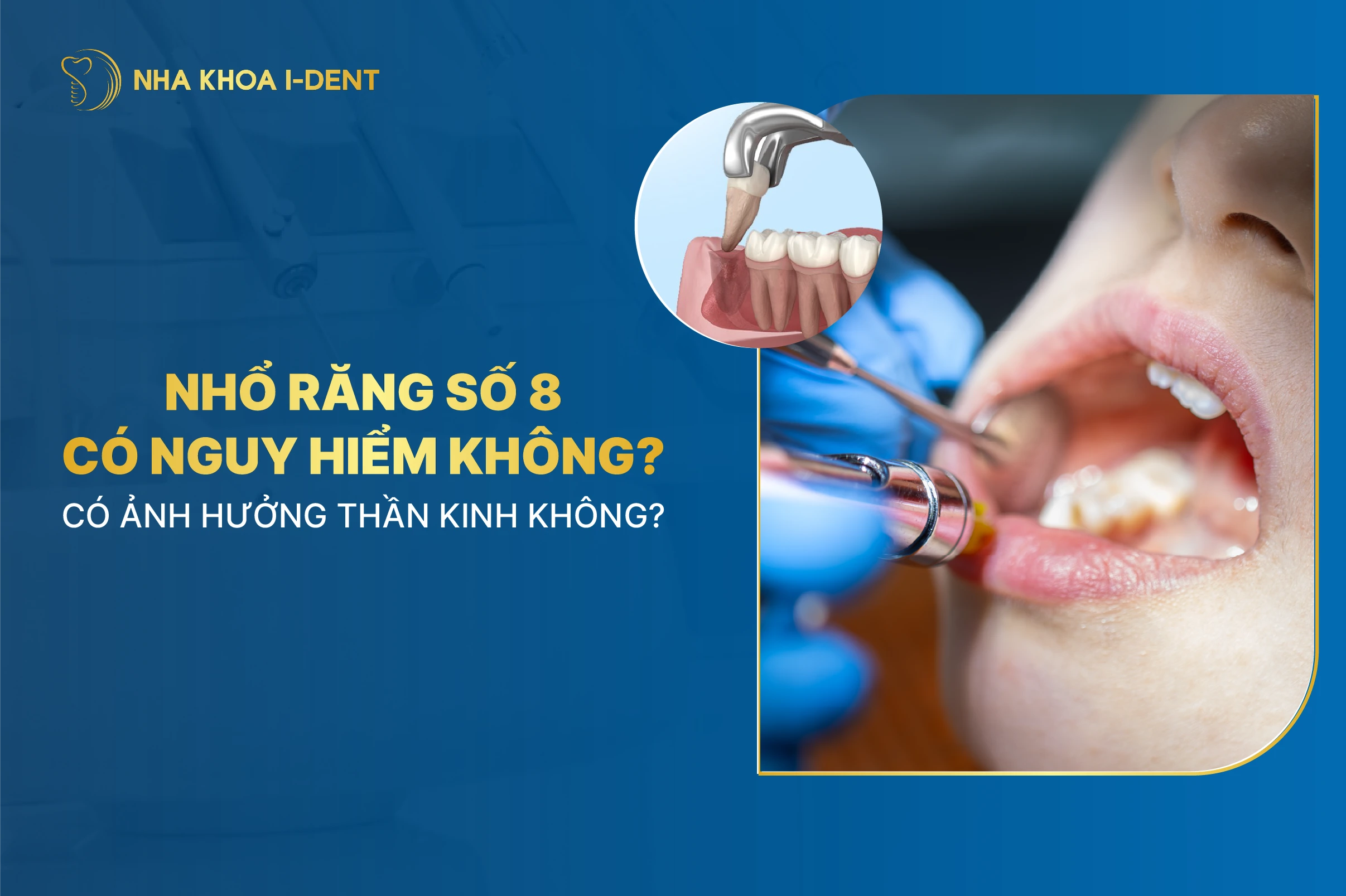 nhổ răng số 8 có nguy hiểm không