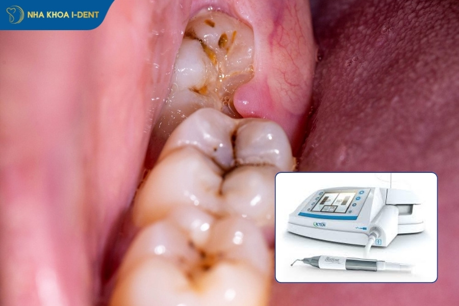 nhổ răng số 8 hàm dưới có nguy hiểm không