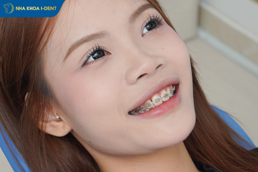 niềng răng bị tiêu xương