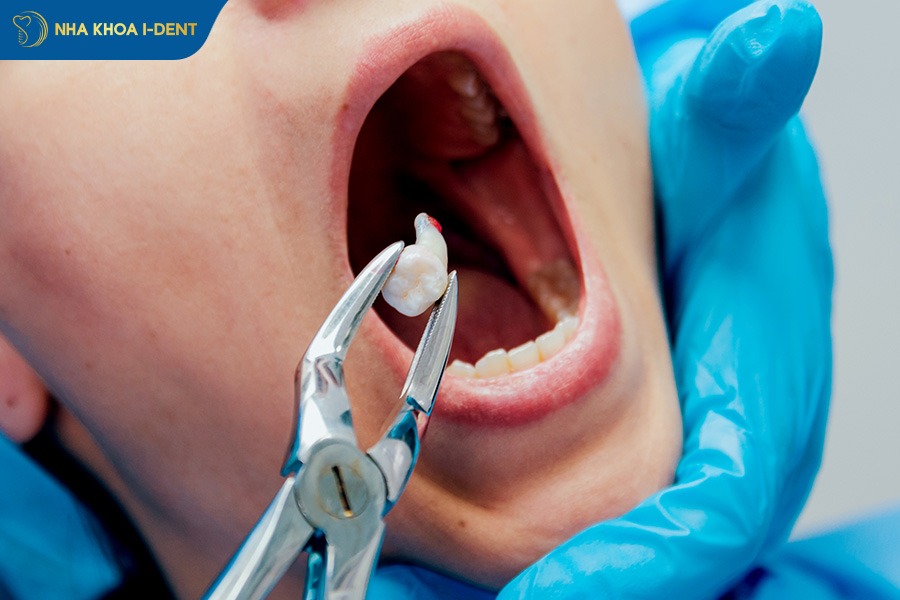 Niềng răng cần nhổ răng để tạo khoảng trống