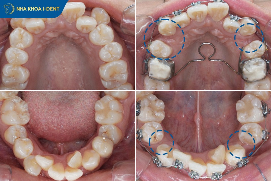 Số lượng răng cần nhổ khi niềng còn tùy thuộc vào tình trạng răng của bệnh nhân
