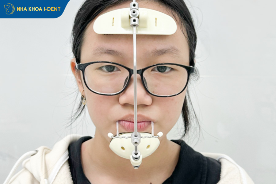 niềng răng tháo lắp có hiệu quả không