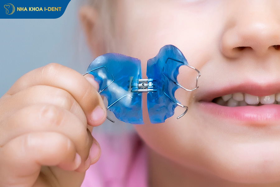 niềng răng tháo lắp kim loại