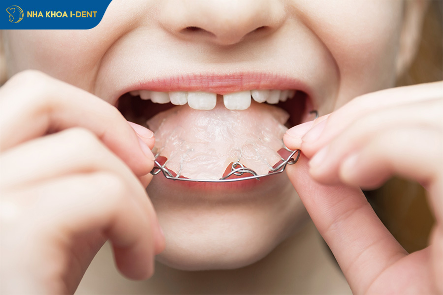 niềng răng tháo lắp