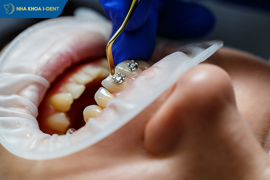 quá trình niềng răng hô