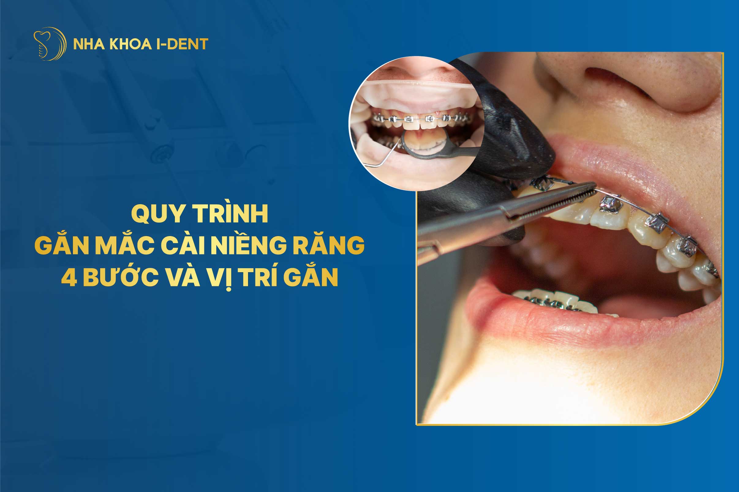 Quy trình gắn mắc cài niềng răng? Vị trí gắn?
