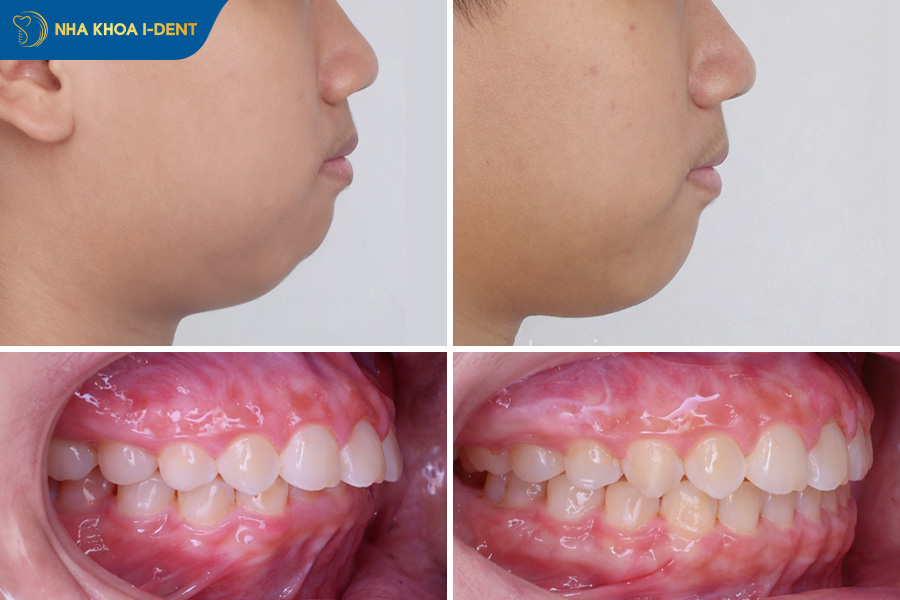 quy trình niềng răng cho trẻ