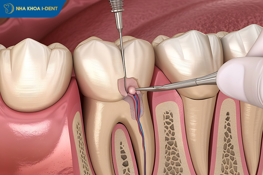 răng chết tủy có niềng được không