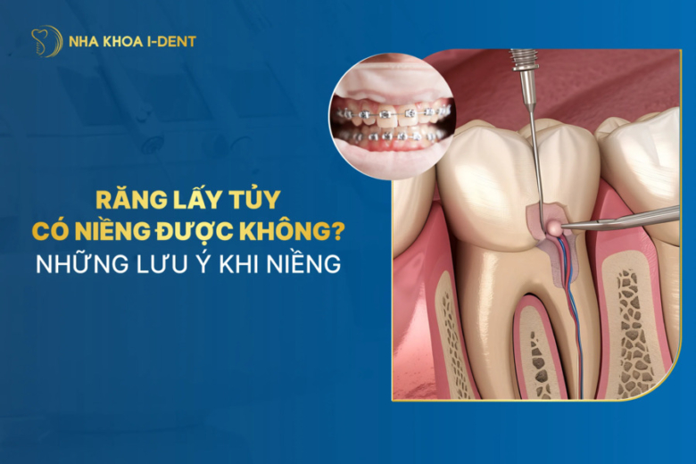 Răng lấy tủy có niềng được không? Cần lưu ý gì khi niềng