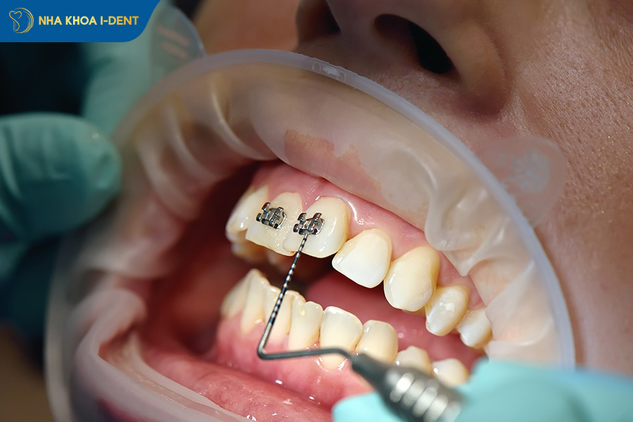 răng đã lấy tủy có niềng răng được không