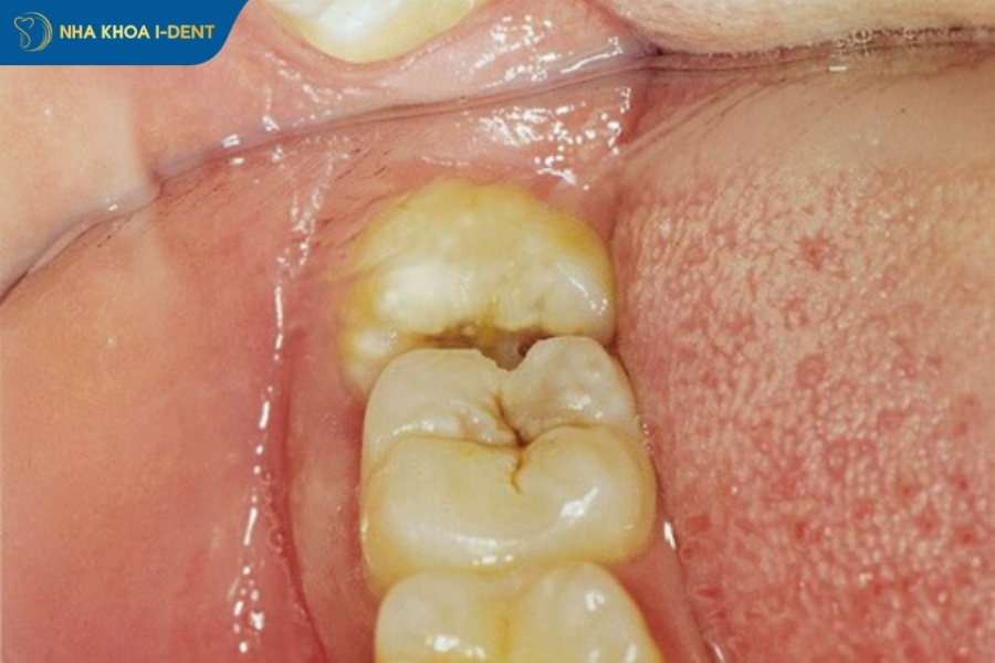 răng khôn mọc lệch có nên nhổ không