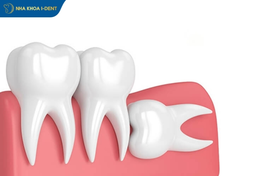 răng khôn mọc lệch không nhổ có sao không