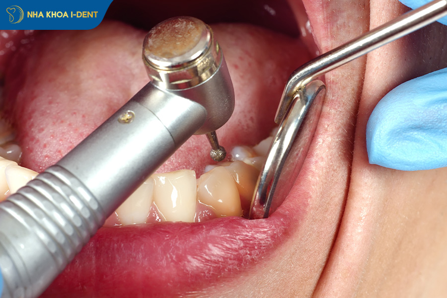 răng lấy tuỷ có niềng được không