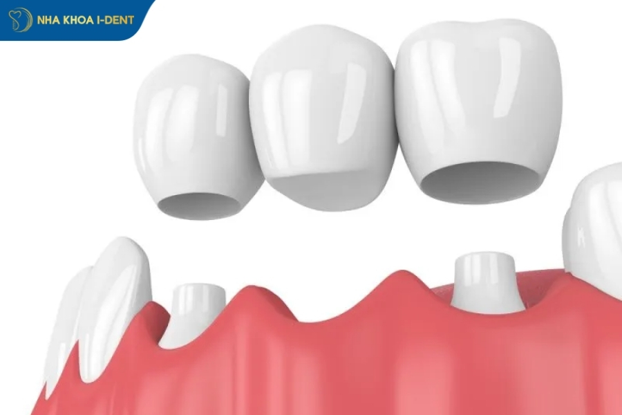 Răng số 7 bị sâu có nên nhổ không