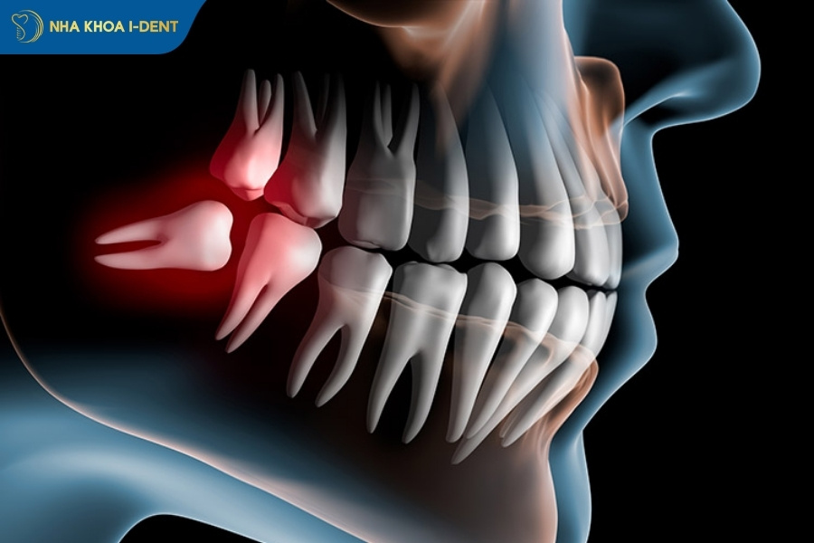 răng số 8 nhổ có ảnh hưởng gì không
