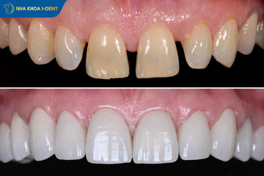 răng thưa nên làm gì