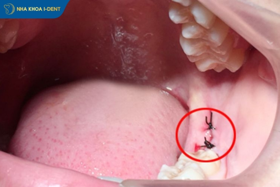 sau khi nhổ răng khôn nên làm gì