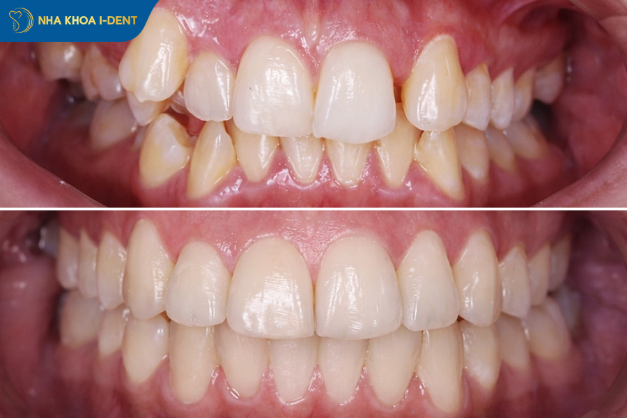 sau khi tháo niềng răng nên làm gì