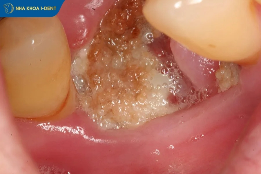 tác hại nhổ răng số 4