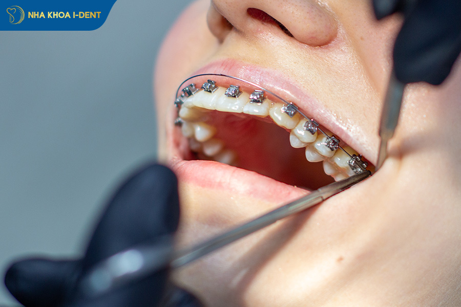 tháo mắc cài niềng răng