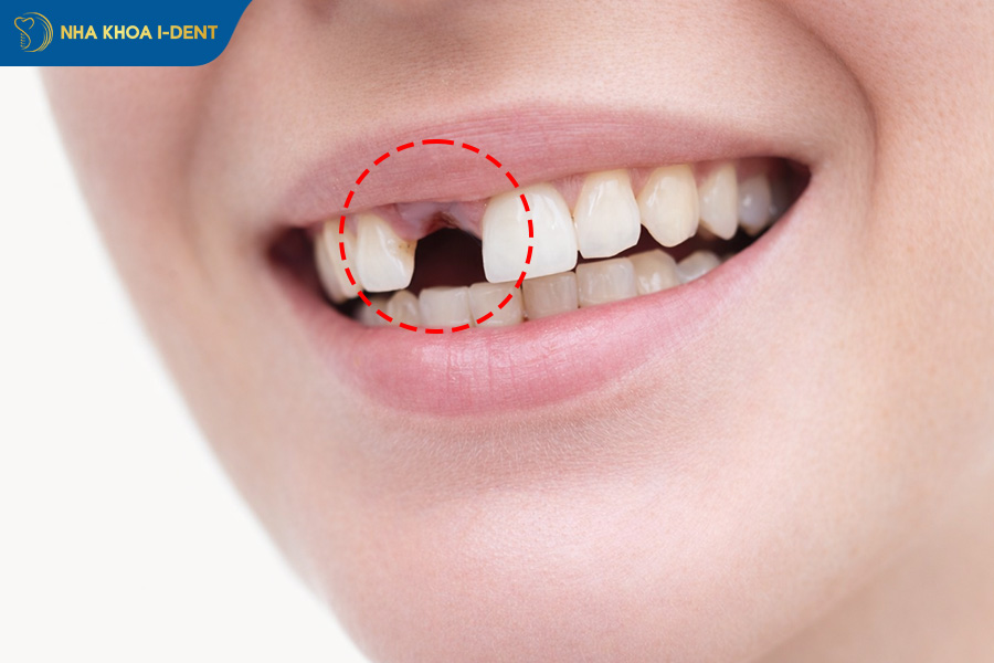 trồng răng cửa mất bao lâu