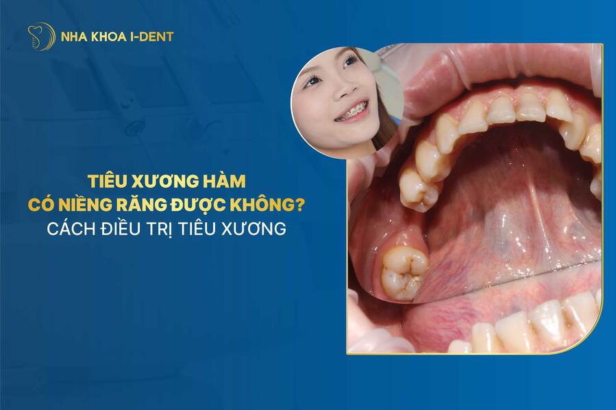 tiêu xương hàm có niềng răng được không