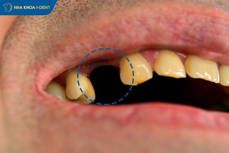 Mất răng số 4 gây tiêu xương hàm