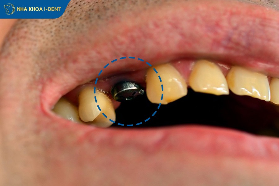 Trồng implant răng số 4
