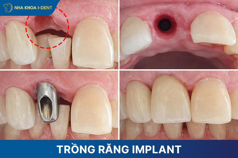 trồng răng implant răng cửa