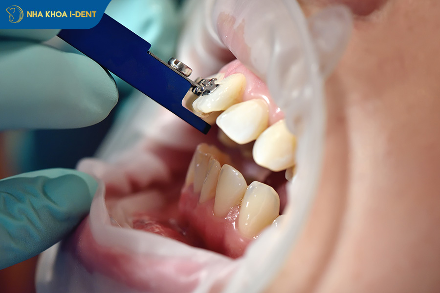 tư vấn niềng răng online