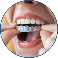 Invisalign Lite