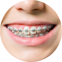 Self Ligating Metal Braces