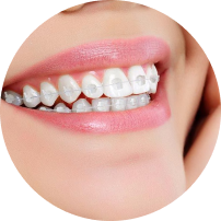 Standard Ceramic Braces