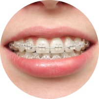 Self Ligating Ceramic Braces